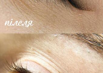 До і після перманент ока